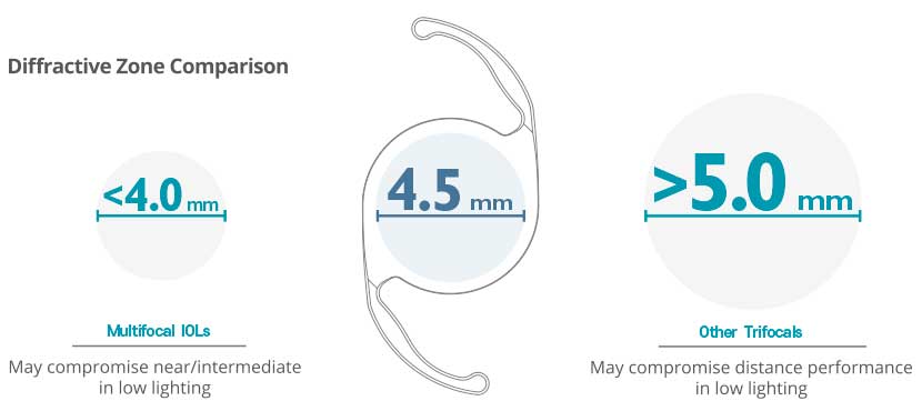 팬옵틱스 삽입술
