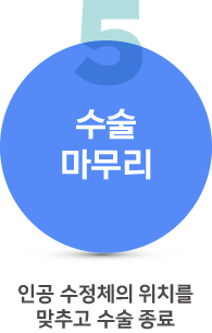 백내장수술과정5