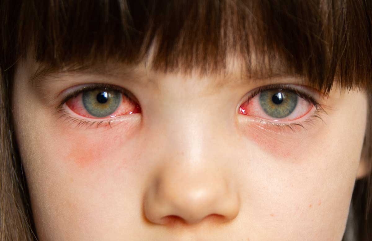 포도막염 포도막염